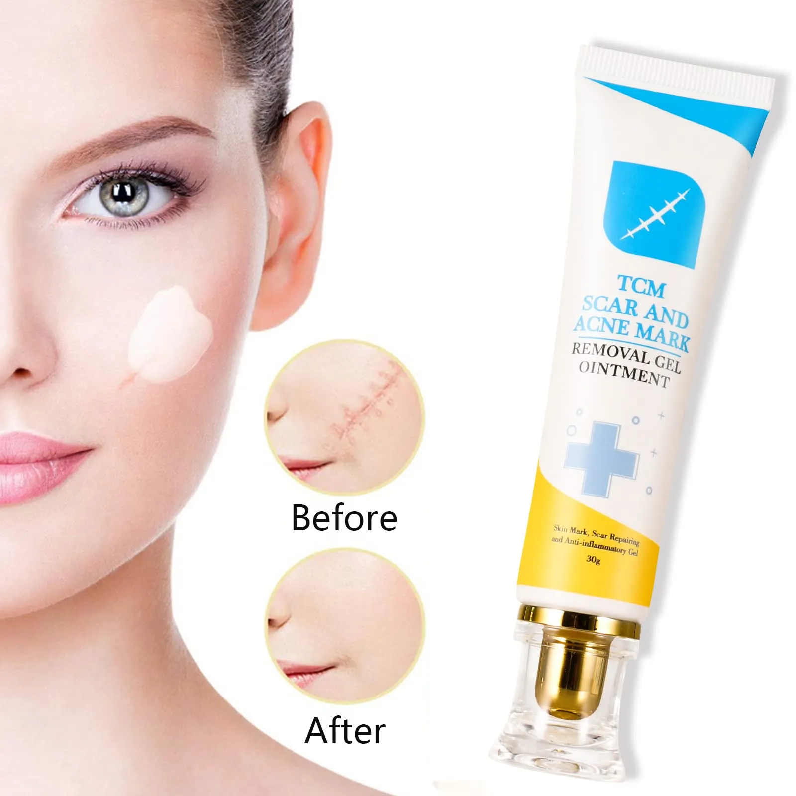 2pcs Scar and Acne Marks Removal Ointment Gel, Scar Removal Cream, Skin Repair Scars Burns Cuts, Stretch Marks, Acne Spots, Scar Gel 30gx2