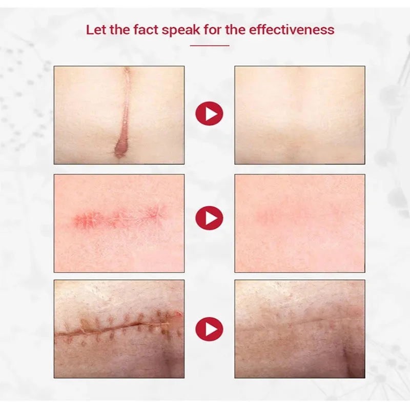 3 pc Skin Repair Scar Removal Gel Cream - 20gm