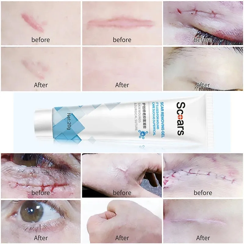 3 pc Skin Repair Scar Removal Gel Cream - 20gm