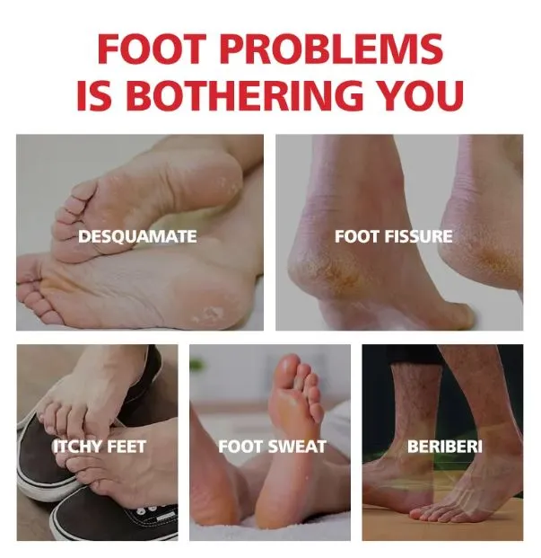 Aichun beauty moisturizing foot cream, dead skin care cream, foot removal cream for cracked heels 20g AC2042