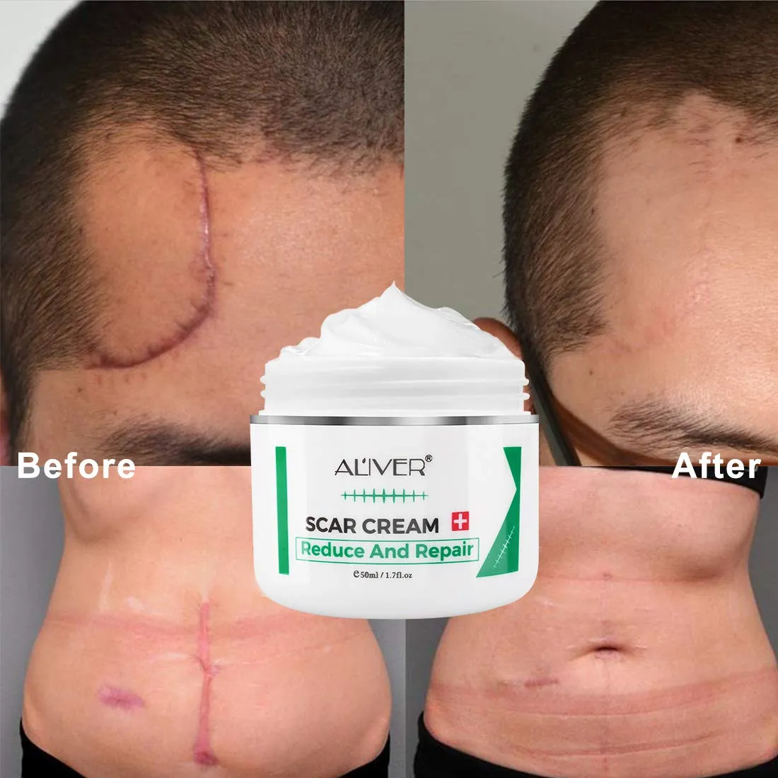 Aliver Scar Removal Cream for Old & New Scars, Stretch Mark Remover for Men & Women, Acne Scar Removal on Face or Body, Scar Treatment for Cuts,Surgery, Burn, Cut, Keloid, C-Section