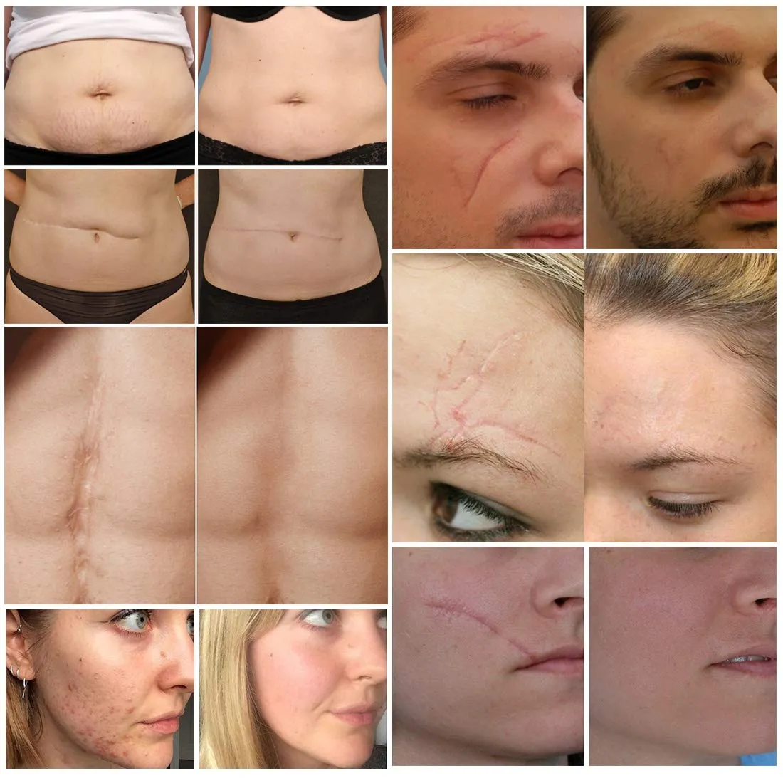 Aliver Scar Removal Cream for Old & New Scars, Stretch Mark Remover for Men & Women, Acne Scar Removal on Face or Body, Scar Treatment for Cuts,Surgery, Burn, Cut, Keloid, C-Section