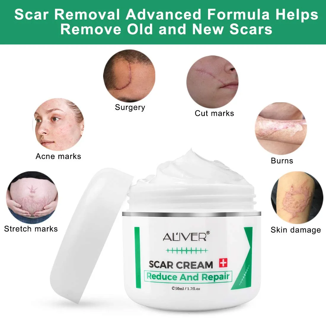 Aliver Scar Removal Cream for Old & New Scars, Stretch Mark Remover for Men & Women, Acne Scar Removal on Face or Body, Scar Treatment for Cuts,Surgery, Burn, Cut, Keloid, C-Section