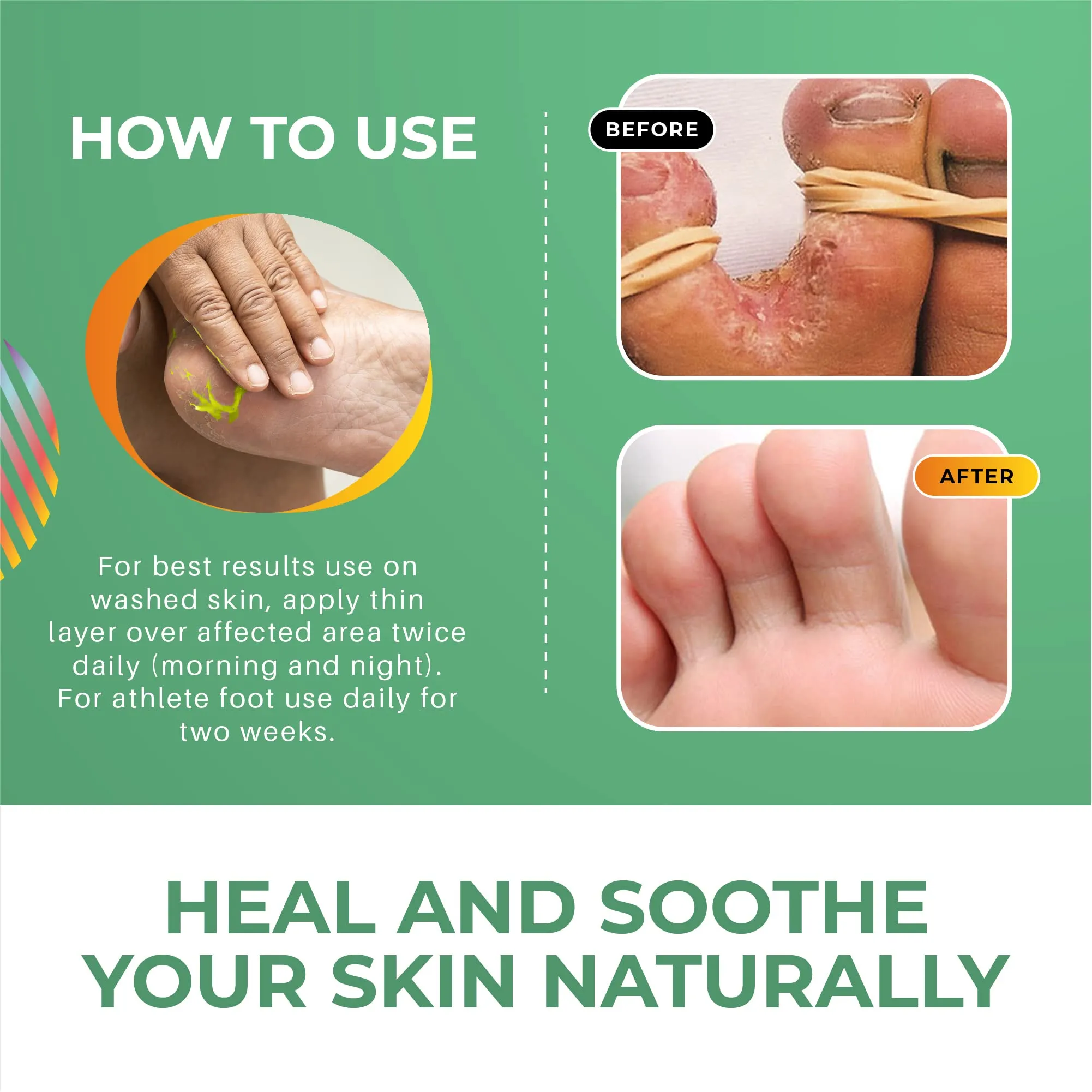 Athletes Foot Treatment | Athletes Foot Cream Extra Strong - Skin Hero | Anti-fungal Foot Treatment | Cooling Anti-fungal Cream for Feet 50g