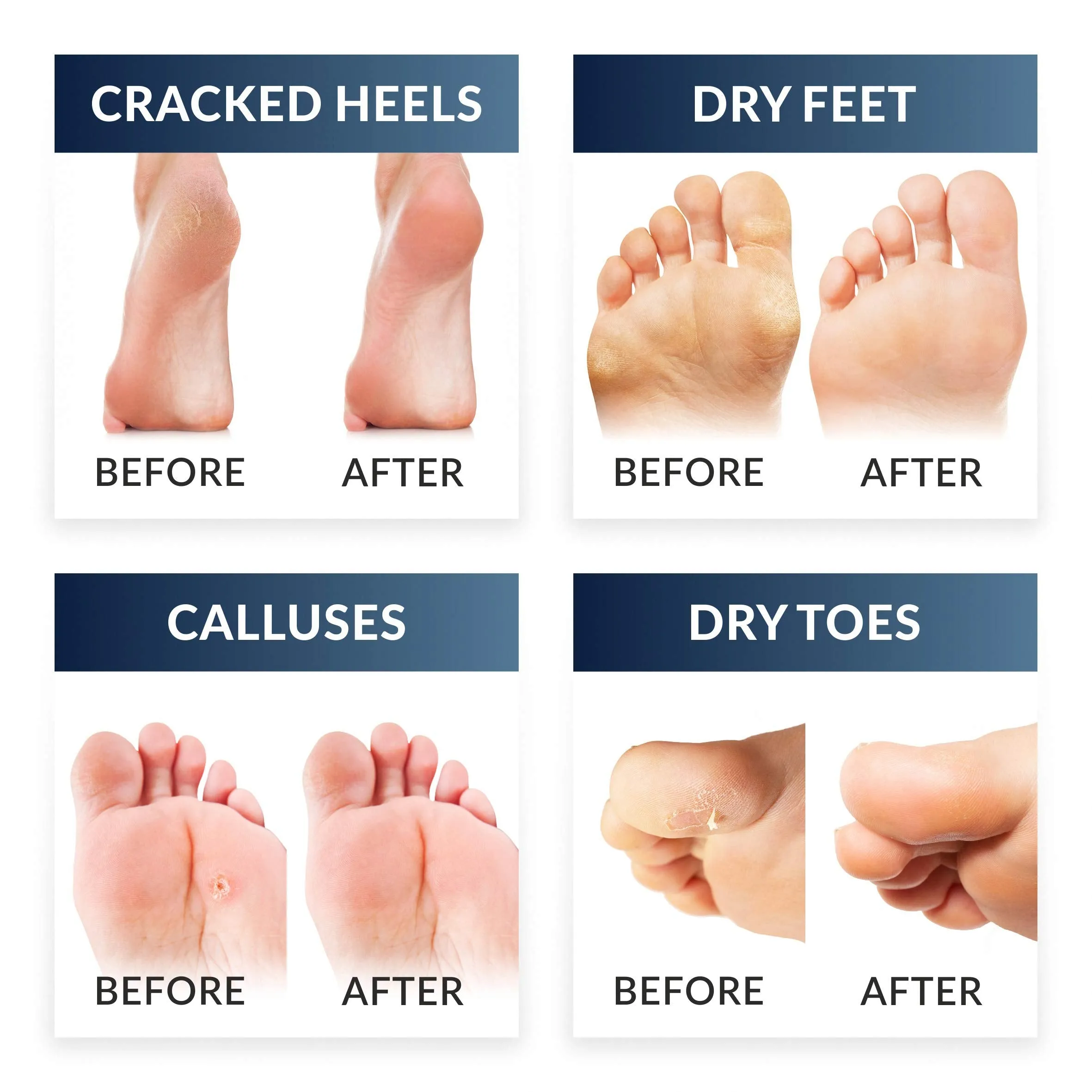 Baby Feet Foot Peel Mask Foot Masks for Men remove hard skin Exfoliating Socks Callus Remover pedicure Exfoliator Foot Peeling Mask Foot Care Kit for cracked Feet Pack 1 Pair (up to size 12)