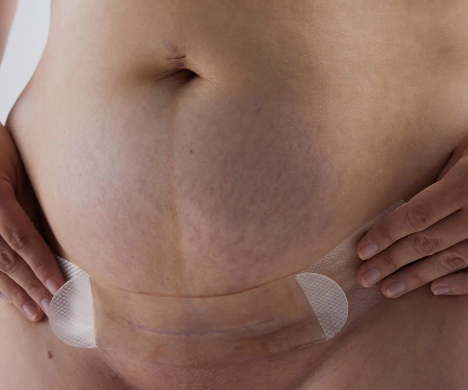 Bare Mum Silicone Gel Scar Strips