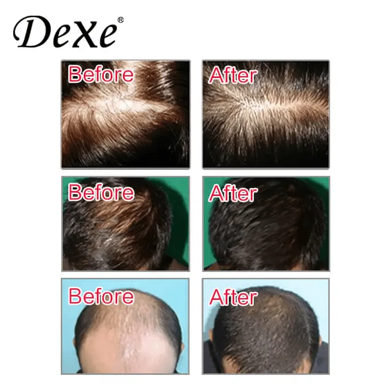 Dexe Anti-Hair Loss Lotion - 6mlx10