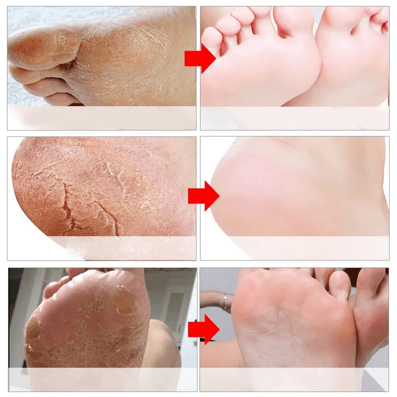 Exfoliating Foot Masks Pedicure Socks