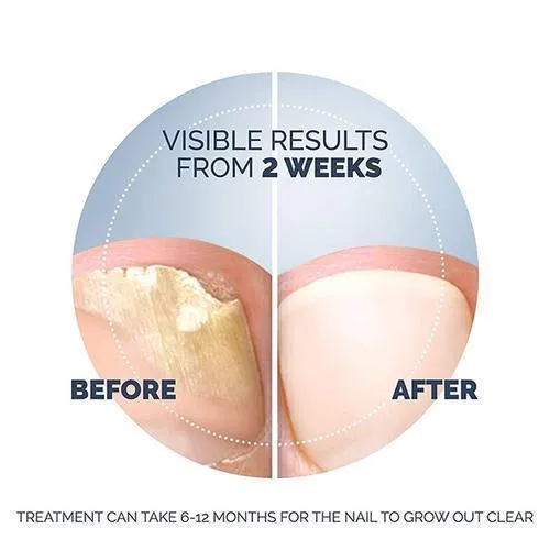 Fungal Nail Treatment