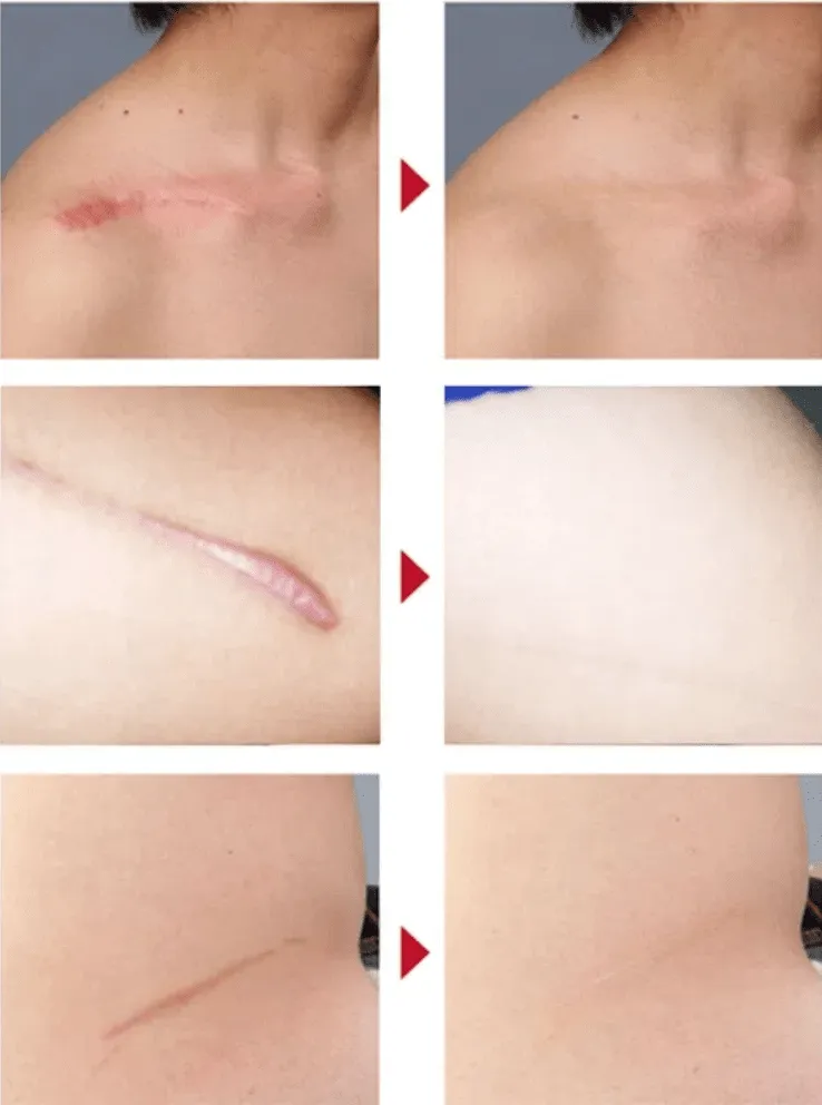Gel Scar Therapy Patch