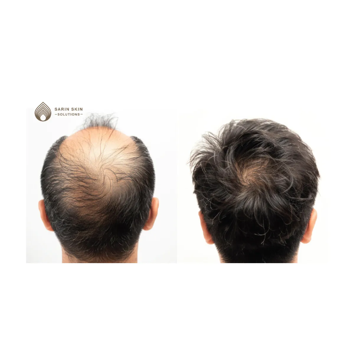 Hair Transplant By Sarin Skin Services
