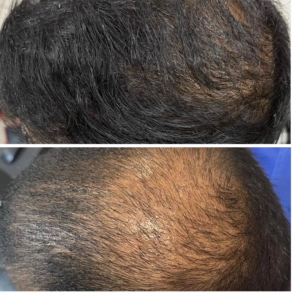 Hair Transplant By Sarin Skin Services