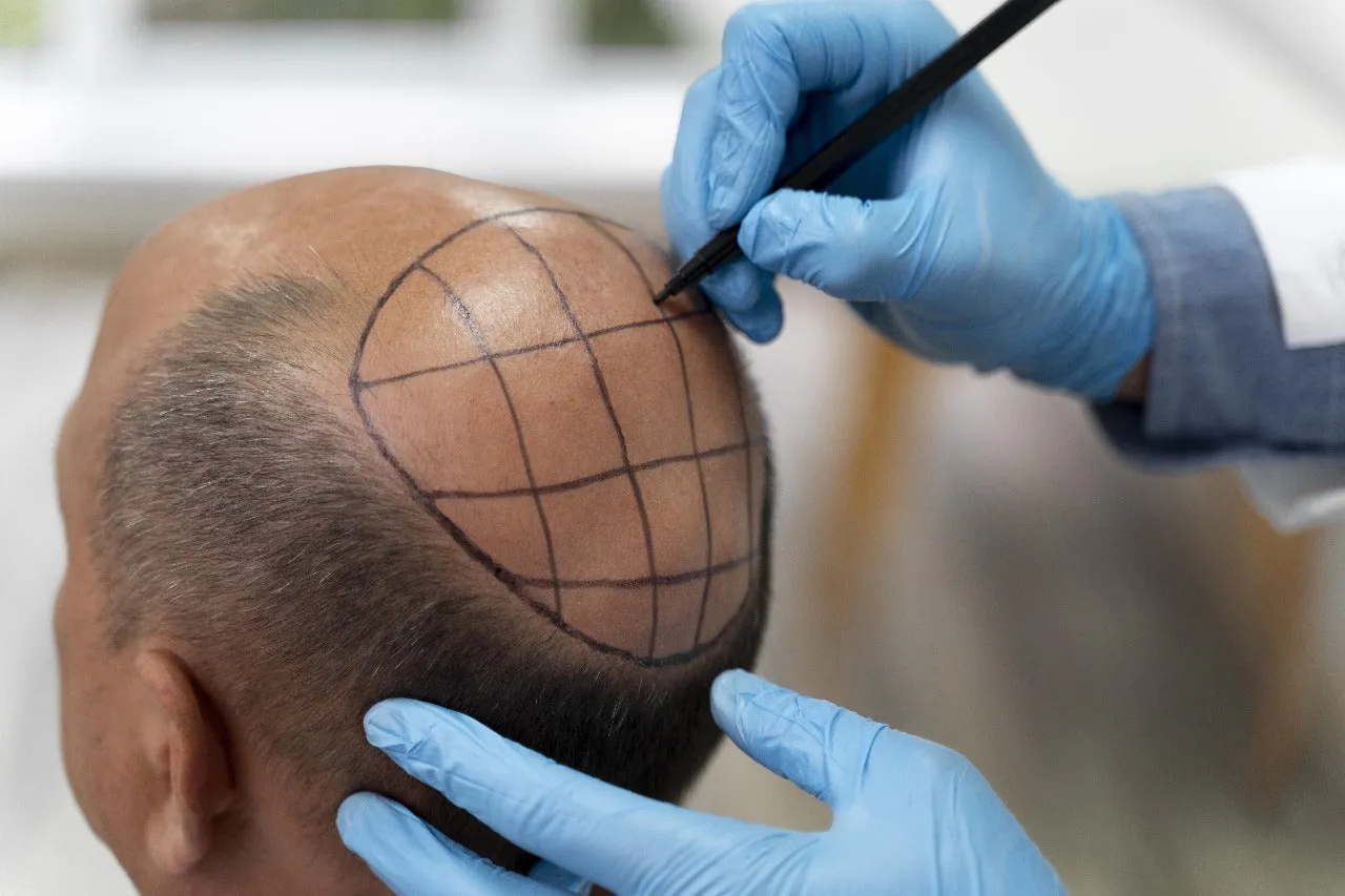 Hair Transplant By Sarin Skin Services