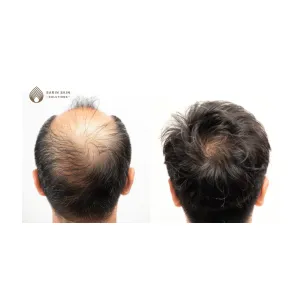 Hair Transplant By Sarin Skin Services