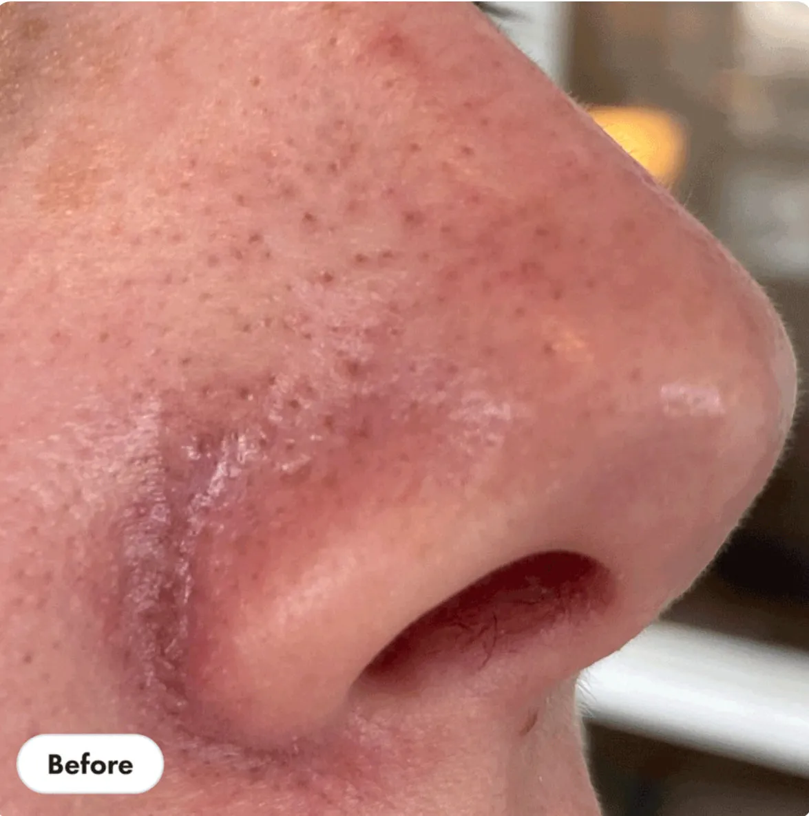 HERO pore release blackhead clear solution 2% salicylic acid acne treatment