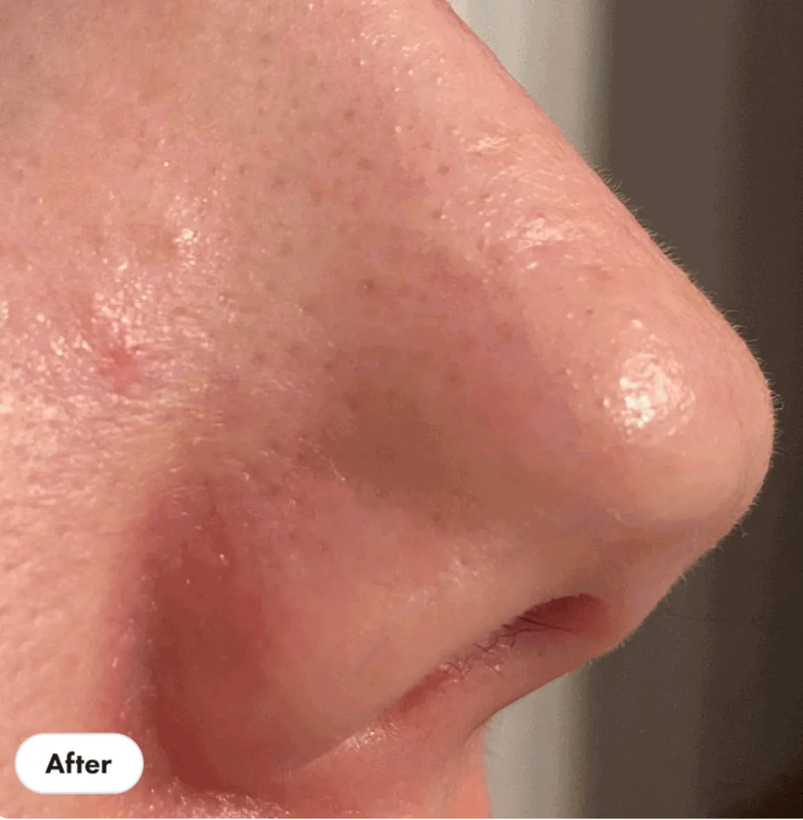 HERO pore release blackhead clear solution 2% salicylic acid acne treatment