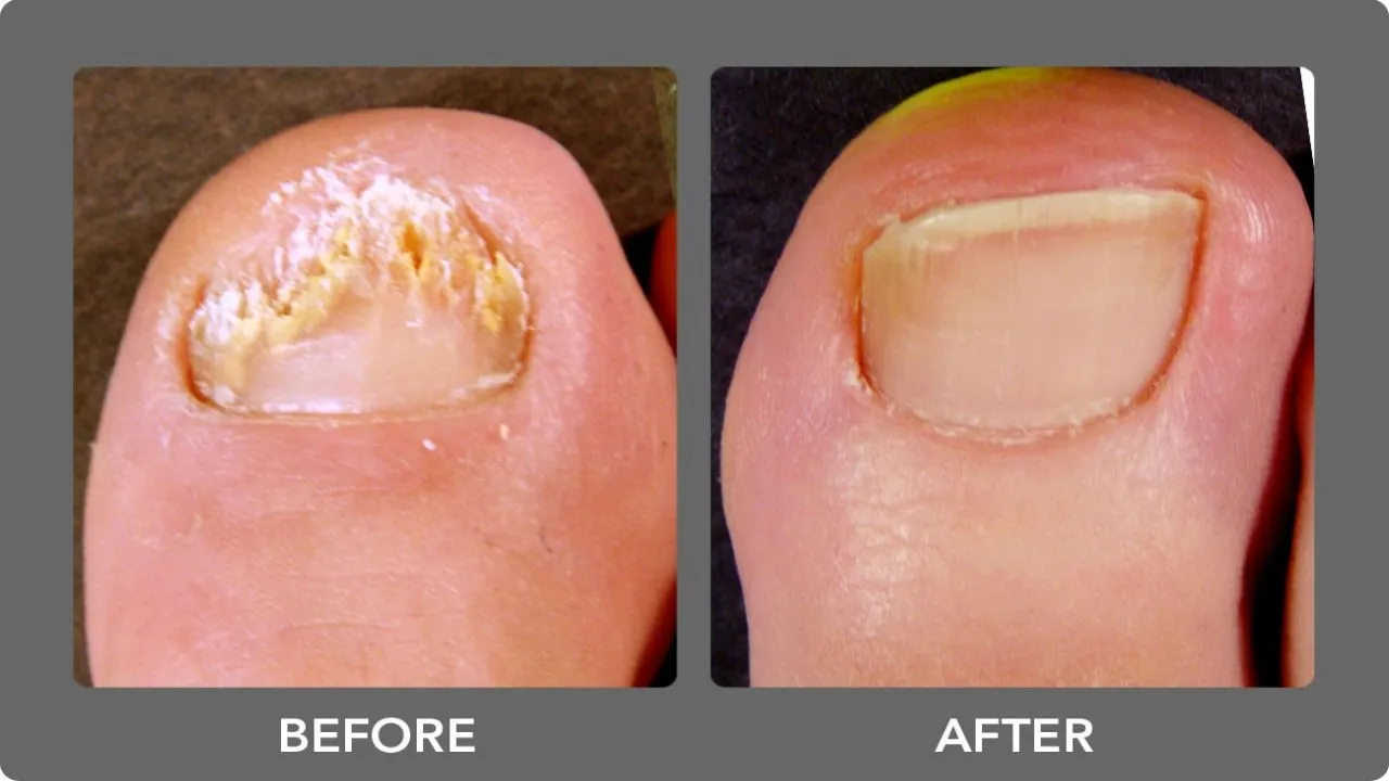 Kerasal Nail Fungal Nail Renewal Treatment