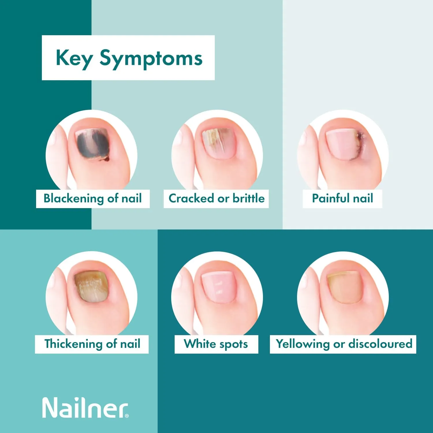 Nailner 2-in-1 Fungal Nail Treatment Brush, 5ml - Healthy & Bright Nails