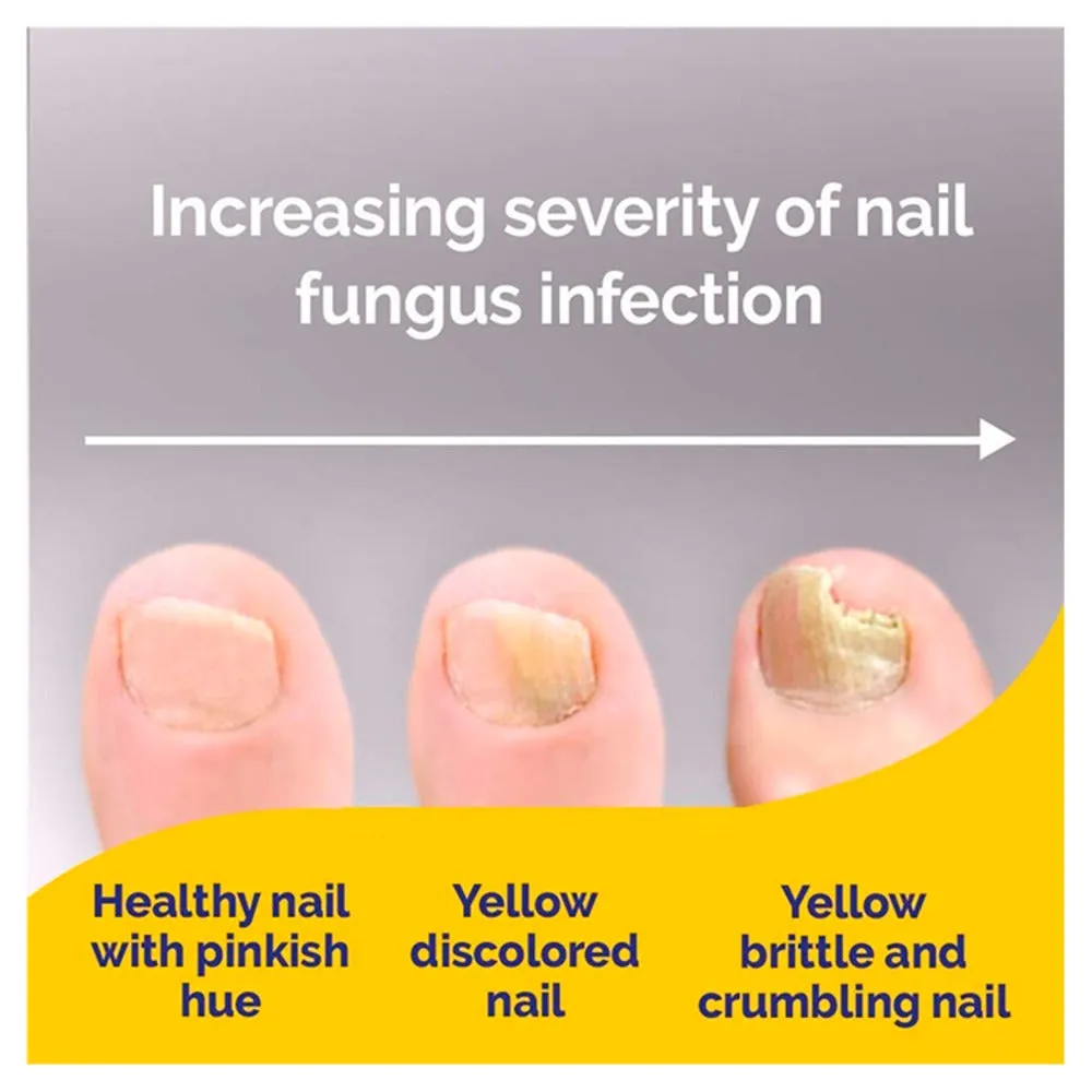 Schollmed fungal nail complete treatment kit