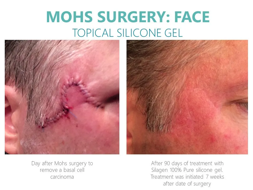 Silagen 100% Pure Gel 15g
