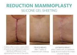 Silagen Anchor Clear Sheet