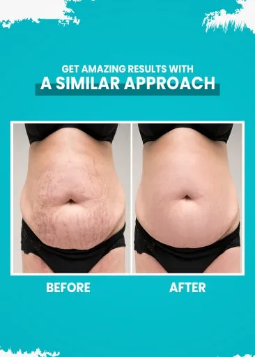 Stretch Mark Removal Cream (50G)