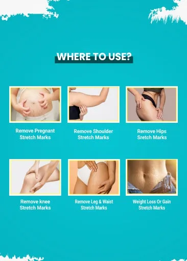 Stretch Mark Removal Cream (50G)