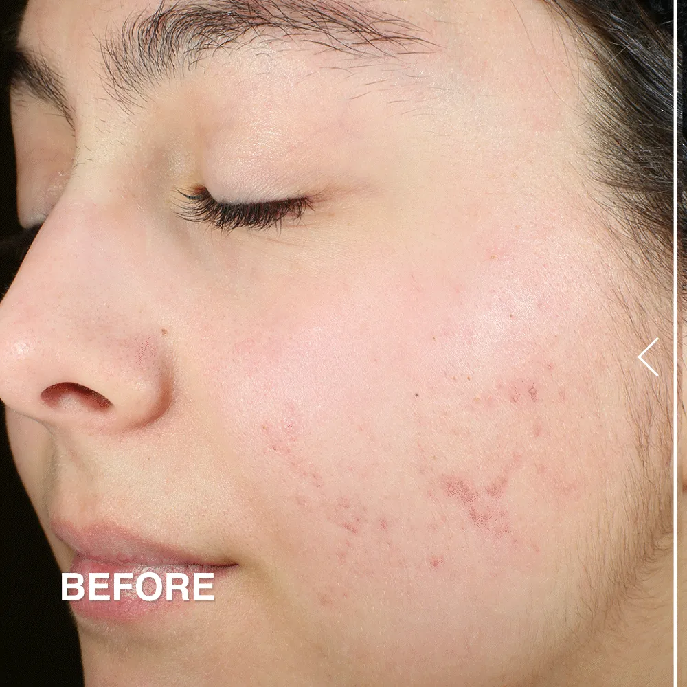Sulfur Spot Treatment